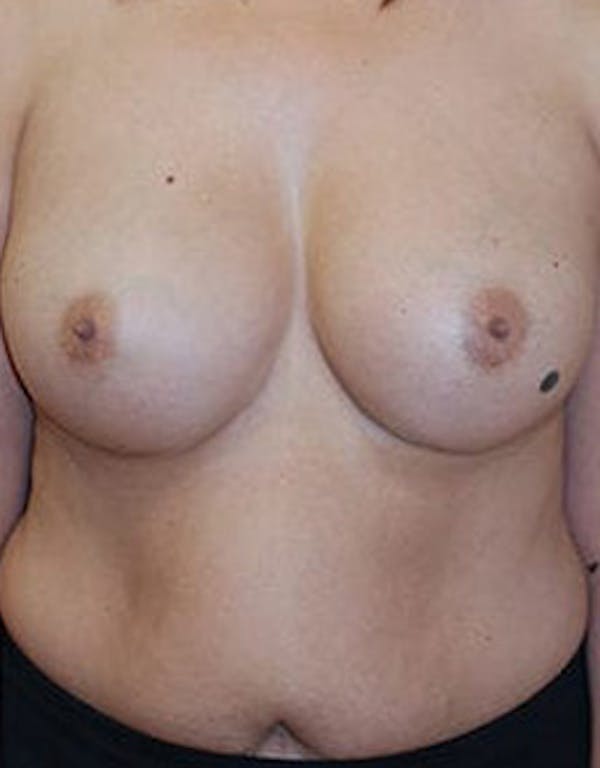 Breast Augmentation Gallery - Patient 4861085 - Image 2
