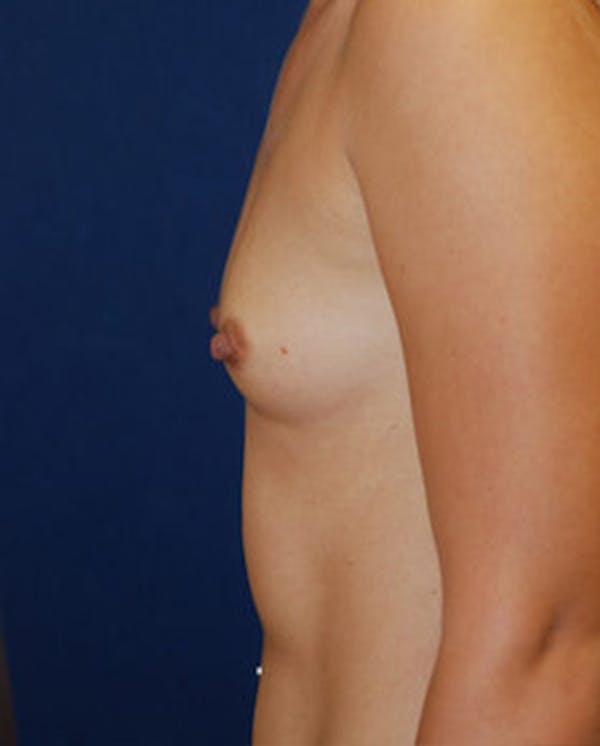 Breast Augmentation Gallery - Patient 4861091 - Image 5