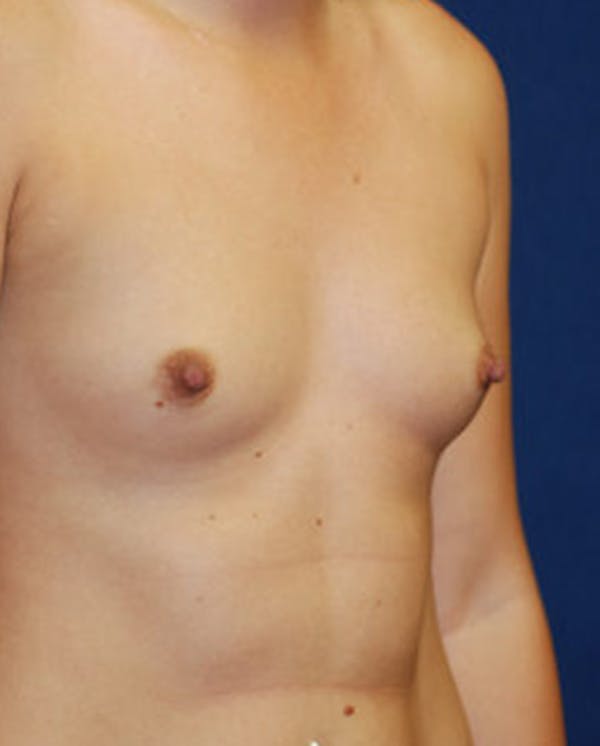 Breast Augmentation Gallery - Patient 4861091 - Image 9