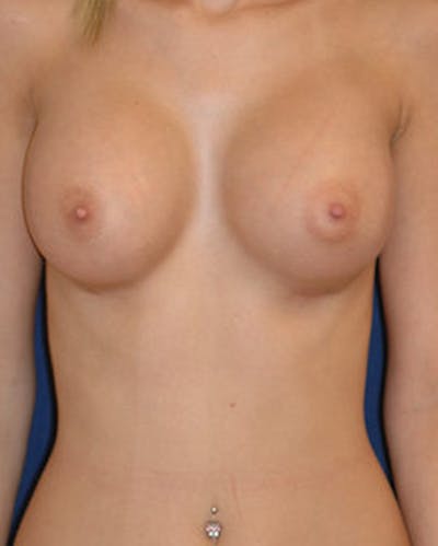 Breast Augmentation Gallery - Patient 4861093 - Image 2
