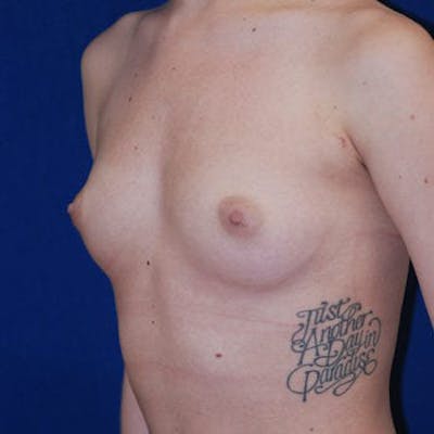 Breast Augmentation Gallery - Patient 4861096 - Image 1