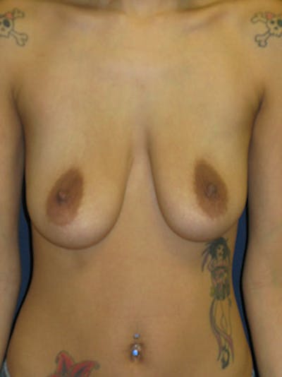 Breast Augmentation Gallery - Patient 4861098 - Image 1