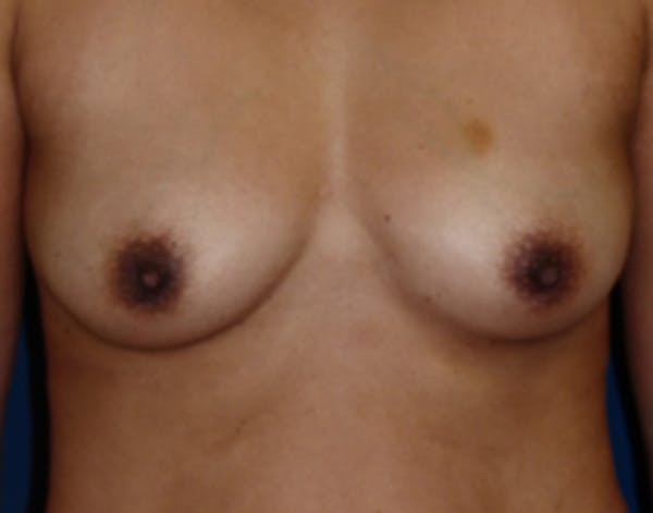 Breast Augmentation Gallery - Patient 4861107 - Image 1