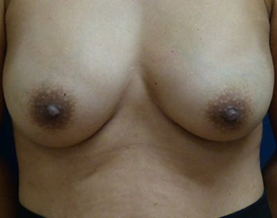 Breast Augmentation Gallery - Patient 4861107 - Image 2