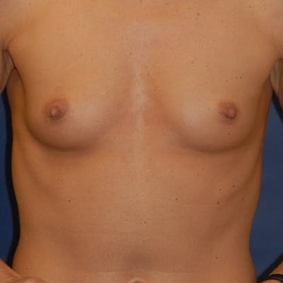 Breast Augmentation Gallery - Patient 4861110 - Image 1