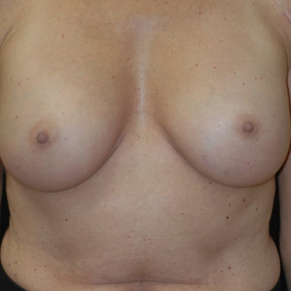 Breast Augmentation Gallery - Patient 4861113 - Image 2