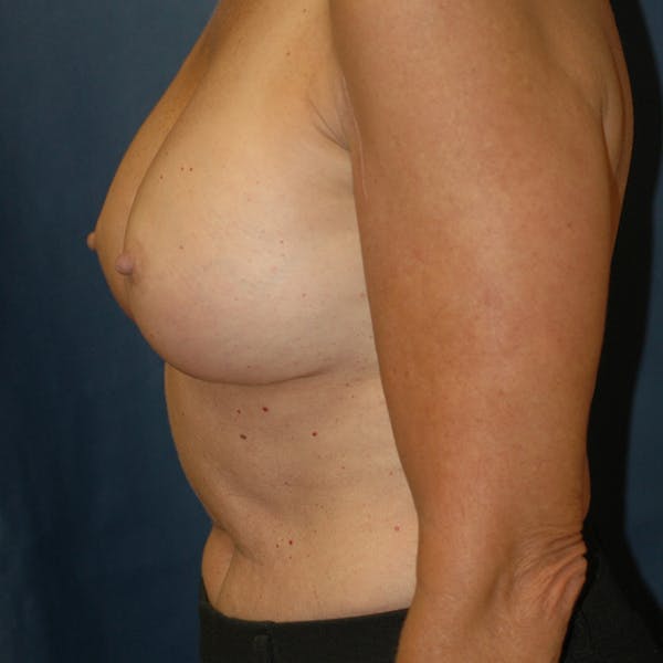 Breast Augmentation Gallery - Patient 4861113 - Image 6