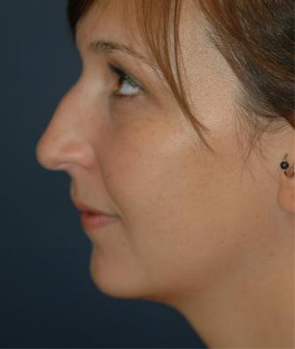 Chin Augmentation Before & After Photos