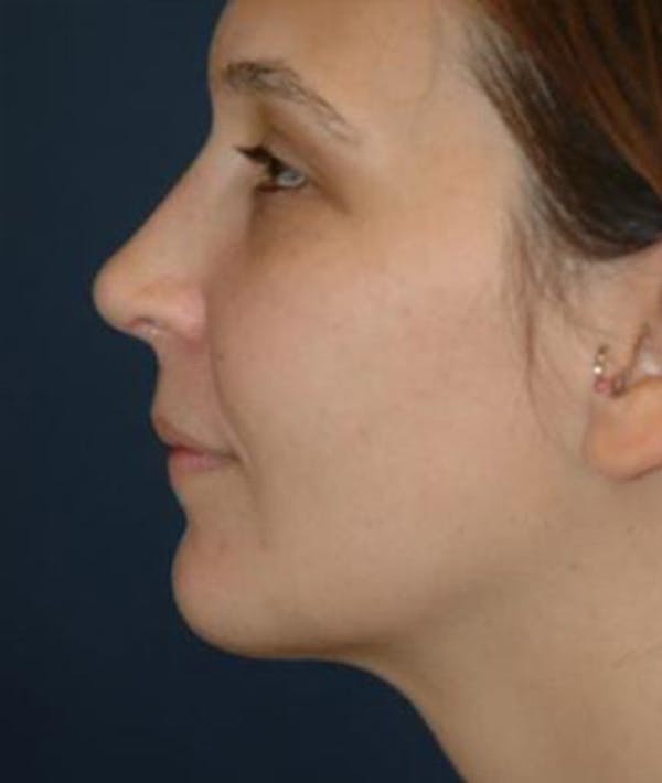 Chin Augmentation Before & After Photos