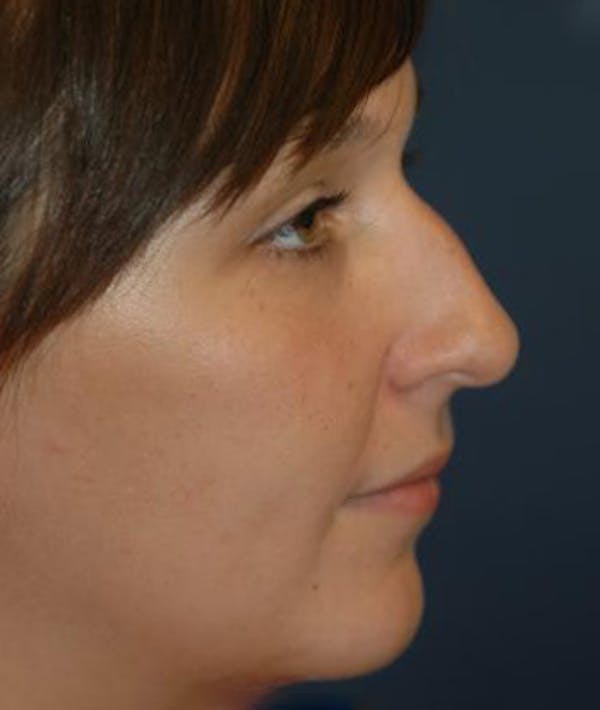 Chin Augmentation Gallery - Patient 4861487 - Image 3