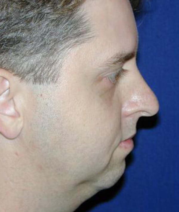Before and After chin augmentation in Houston