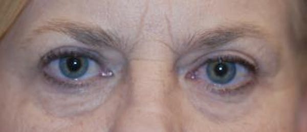 Eyelid Lift (Blepharoplasty) Gallery - Patient 4861501 - Image 3