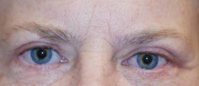 Eyelid Lift (Blepharoplasty) Gallery - Patient 4861501 - Image 4