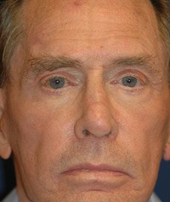 eyelid lift blepharoplasty