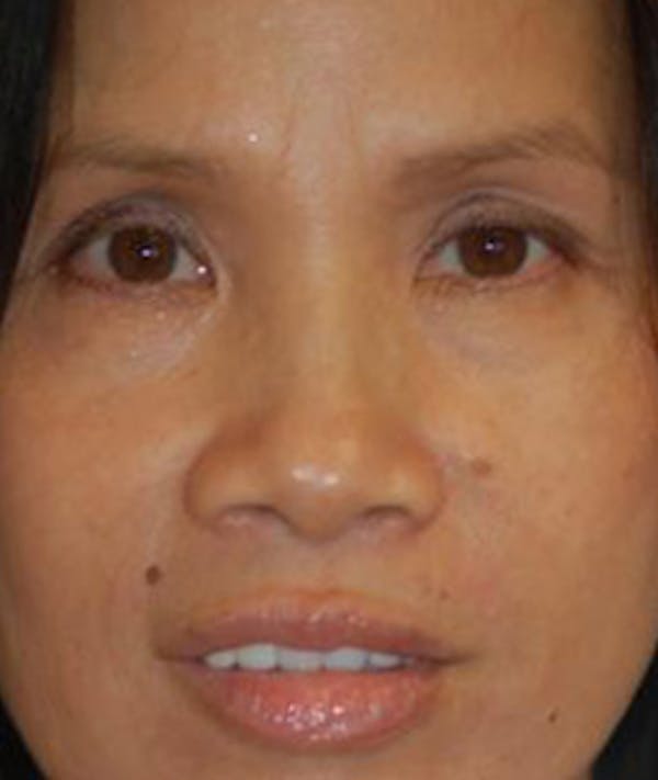 Eyelid Lift (Blepharoplasty) Gallery - Patient 4861508 - Image 1