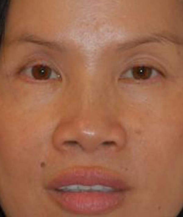 Eyelid Lift (Blepharoplasty) Gallery - Patient 4861508 - Image 2