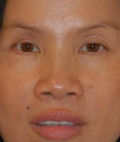 Eyelid Lift (Blepharoplasty) Gallery - Patient 4861508 - Image 2
