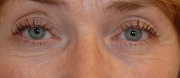 Eyelid Lift (Blepharoplasty) Gallery - Patient 4861512 - Image 3