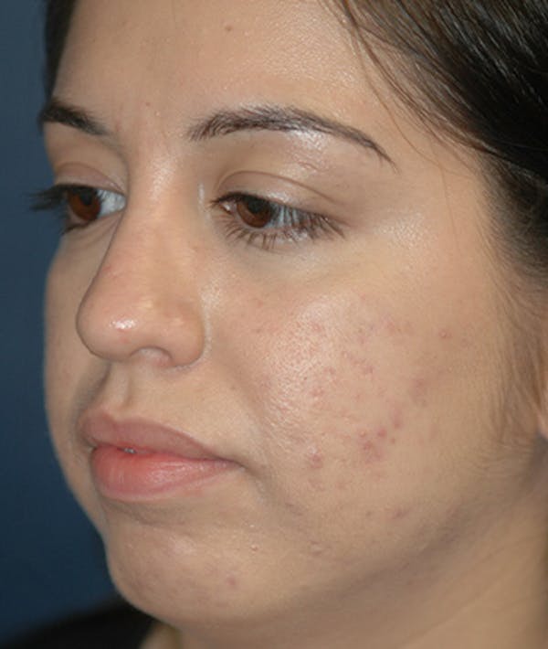 Chin Augmentation Gallery - Patient 4861515 - Image 3