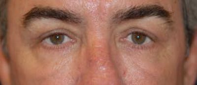 Eyelid Lift (Blepharoplasty) Gallery - Patient 4861514 - Image 4