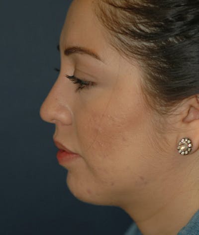 Chin Augmentation Gallery - Patient 4861515 - Image 8