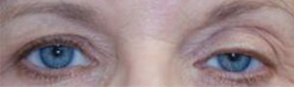 Eyelid Lift (Blepharoplasty) Gallery - Patient 4861516 - Image 3
