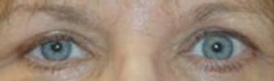 Eyelid Lift (Blepharoplasty) Gallery - Patient 4861516 - Image 4