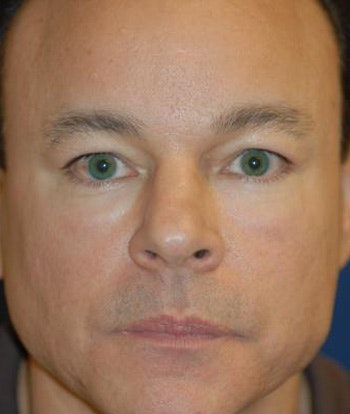eyelid lift blepharoplasty