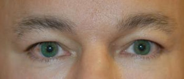 Eyelid Lift (Blepharoplasty) Gallery - Patient 4861524 - Image 3