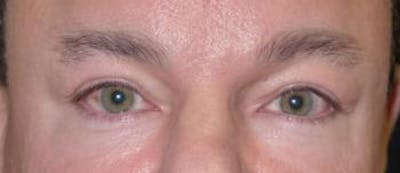 Eyelid Lift (Blepharoplasty) Gallery - Patient 4861524 - Image 4