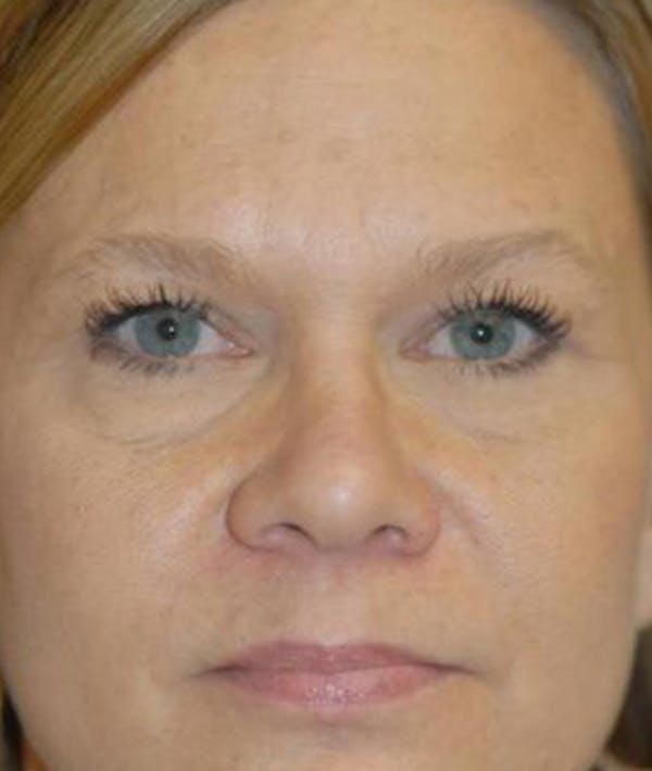 Eyelid Lift (Blepharoplasty) Gallery - Patient 4861527 - Image 2