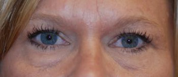 Eyelid Lift (Blepharoplasty) Gallery - Patient 4861527 - Image 3