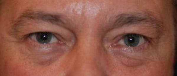 Eyelid Lift (Blepharoplasty) Gallery - Patient 4861531 - Image 3