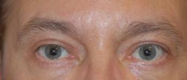 Eyelid Lift (Blepharoplasty) Gallery - Patient 4861531 - Image 4