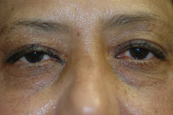 Eyelid Lift (Blepharoplasty) Gallery - Patient 4861532 - Image 3