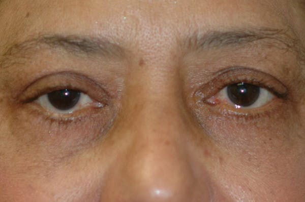 Eyelid Lift (Blepharoplasty) Gallery - Patient 4861532 - Image 4