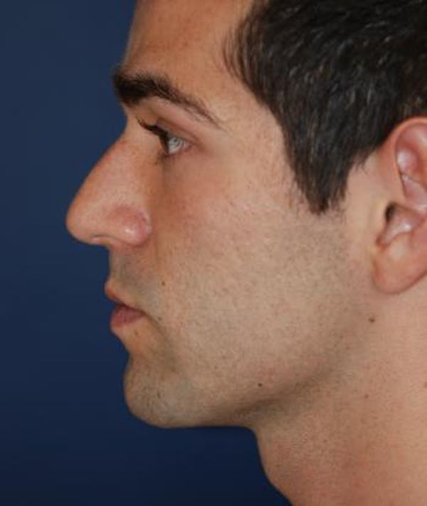 Houston Rhinoplasty Before and After