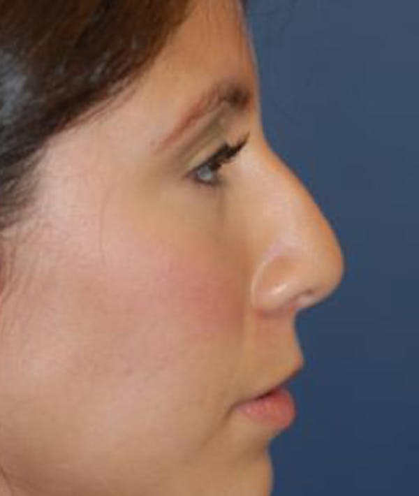 Rhinoplasty Gallery - Patient 4861544 - Image 3