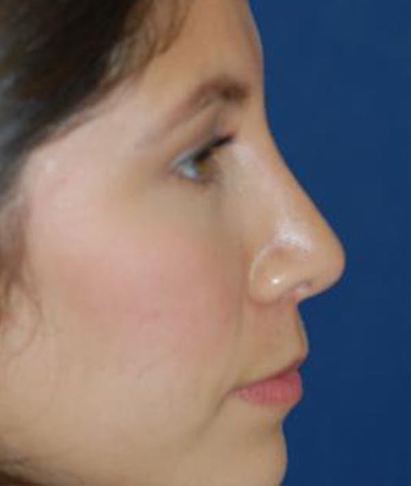 Rhinoplasty Gallery - Patient 4861544 - Image 4