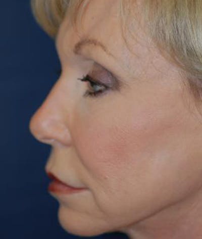 Facelift Gallery - Patient 4861547 - Image 4