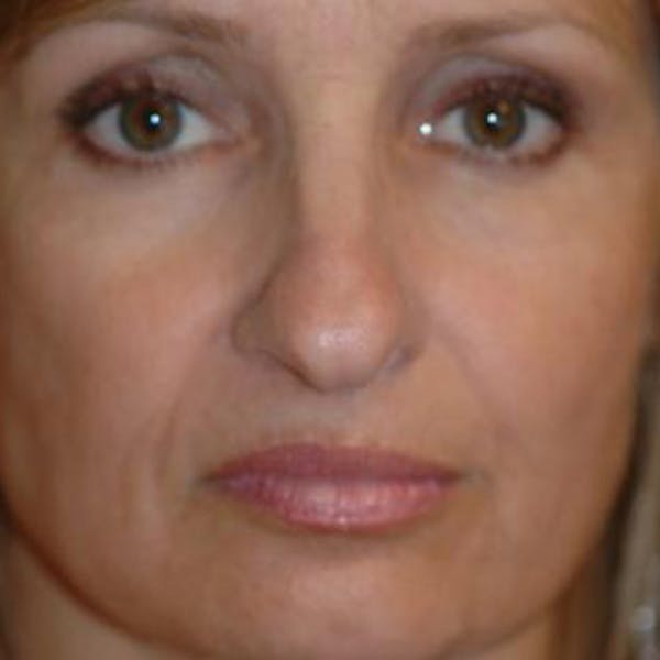 Rhinoplasty Gallery - Patient 4861550 - Image 1