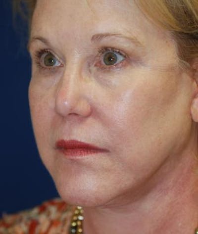 Facelift Gallery - Patient 4861558 - Image 2