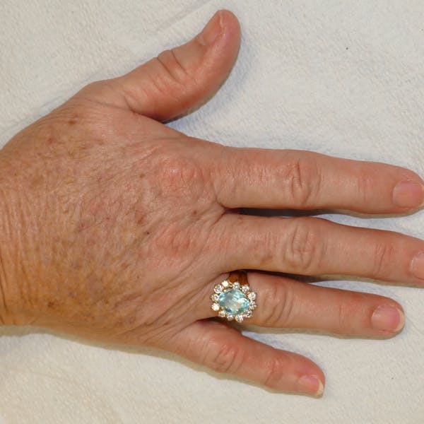 Hand Rejuvenation