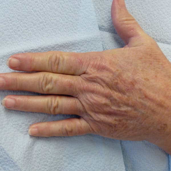 Hand Rejuvenation Gallery - Patient 4861566 - Image 3