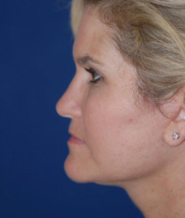 Facelift Gallery - Patient 4861565 - Image 2