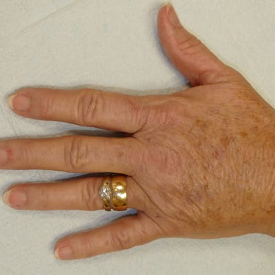 Hand Rejuvenation Gallery - Patient 4861566 - Image 4