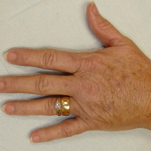 Hand Rejuvenation Gallery - Patient 4861566 - Image 4