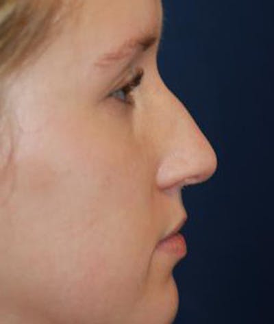 Rhinoplasty Gallery - Patient 4861568 - Image 1