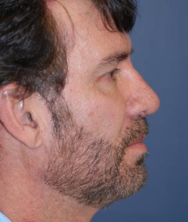 Before and After Male Rhinoplasty in Houston 02