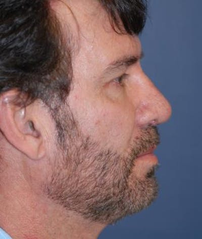 Rhinoplasty Gallery - Patient 4861585 - Image 2